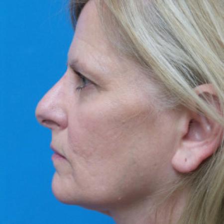 Before image 3 Case #102241 - 56 year old  -  Open Rhinoplasty/Septoplasty/Turbinectomy  -  5 months post-op