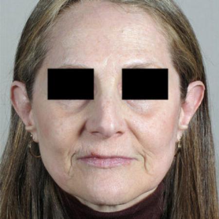 Before image 1 Case #103151 - Rhinoplasty Patient 58