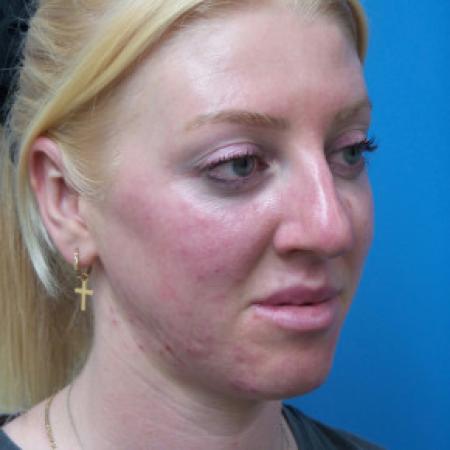 Before image 2 Case #102326 - 29 year old  -  Open Rhinoplasty  -  3 months post-op