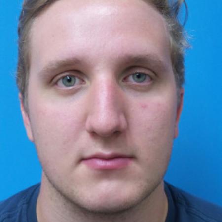 Before image 3 Case #102296 - 19 year old  -  Open Septo-Rhinoplasty with Inferior Turbinectomies  -  3 months post-op