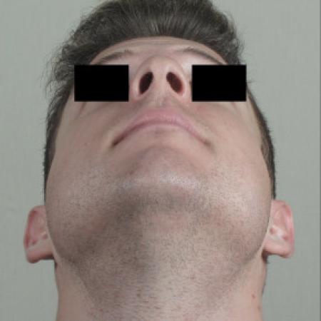Before image 3 Case #103126 - Rhinoplasty Patient 75