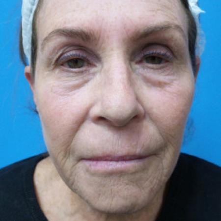 Before image 1 Case #102261 - 71 year old  -  Upper & Lower Blepharoplasty/Upper Lip Lift/Full Face TCA Peel  -  2 months post-op