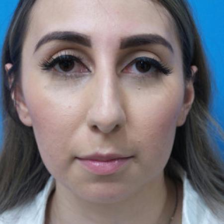 Before image 1 Case #102206 - 30 year old  -  Open Rhinoplasty & Chin Augmentation   3 months post-op