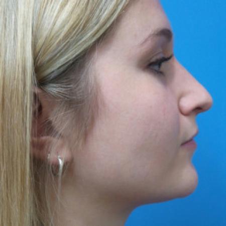 Before image 3 Case #102306 - 25 year old  -  Open Rhinoplasty  -  6 months post-op