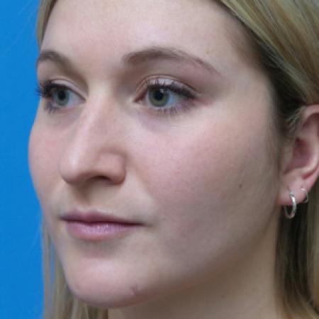 Before image 2 Case #102306 - 25 year old  -  Open Rhinoplasty  -  6 months post-op