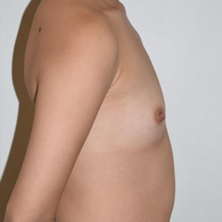 Before image 3 Case #101581 - Breast Augmentation