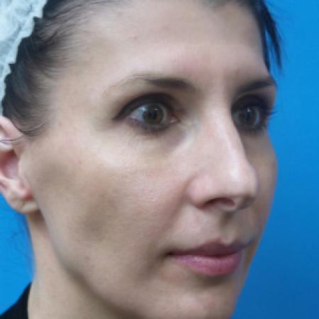 Before image 2 Case #102201 - 42 year old - Open Septo Rhinoplasty  -  7 months post-op