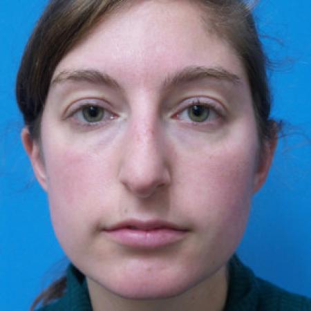 Before image 1 Case #102271 - 28 year old  -  Open Rhinoplasty  -  6 months post-op