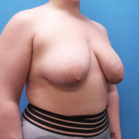 Before image 2 Case #102291 - 29 year old  -  Bilateral Breast Lift  -  4 months post-op