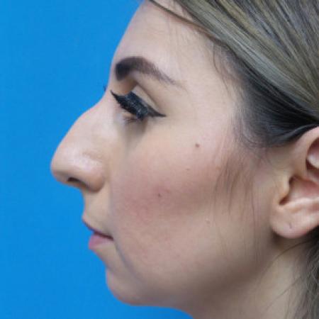 Before image 3 Case #102206 - 30 year old  -  Open Rhinoplasty & Chin Augmentation   3 months post-op