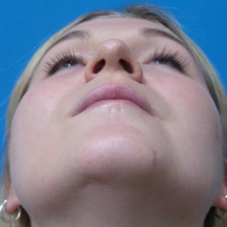 Before image 4 Case #102306 - 25 year old  -  Open Rhinoplasty  -  6 months post-op