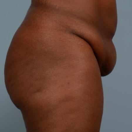 Before image 2 Case #103226 - Tummy tuck with liposuction of hiprolls