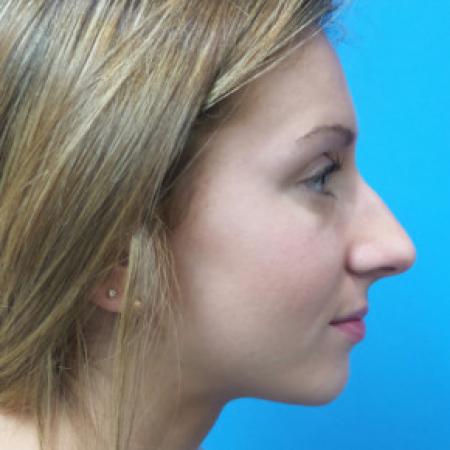Before image 3 Case #102171 - 18 year old - Open Rhinoplasty w/submucous resection/Septoplasty & Spreader grafts to improve airway 