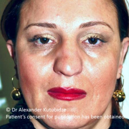 Before image 1 Case #103366 - 8 years after aging aesthetic functional rhinoplasty secondary to previous teen age septoplasty 