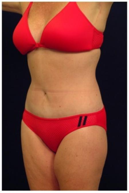 After image 2 Case #81926 - Mommy Makeover