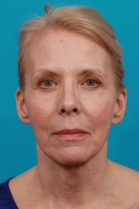 After image 1 Case #83011 - Facial Rejuvenation