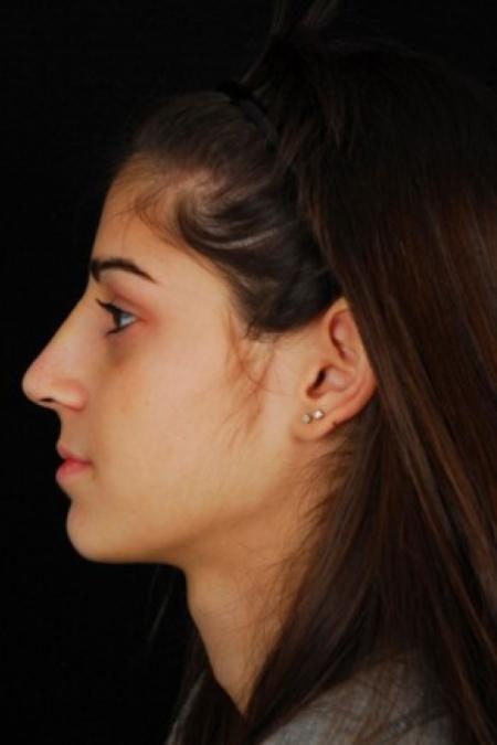 After image 3 Case #81561 - Rhinoplasty