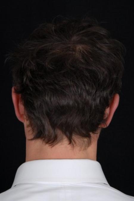 After image 2 Case #81541 - Otoplasty