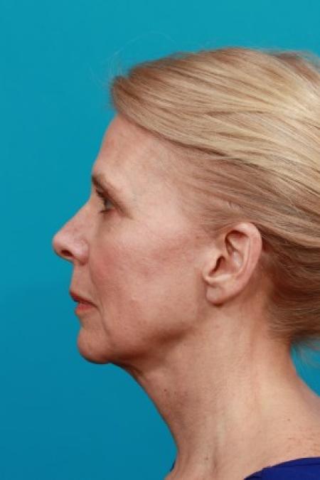 After image 3 Case #83011 - Facial Rejuvenation