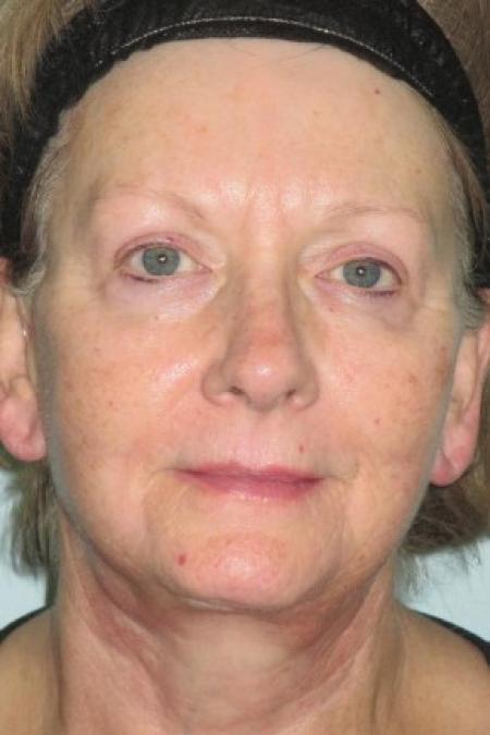After image 1 Case #82681 - 67 Year Old Woman's Facial Rejuvenation