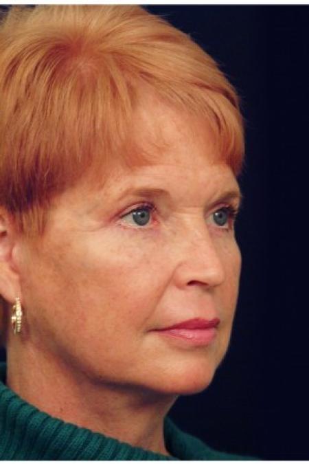 After image 2 Case #82141 - Facelift