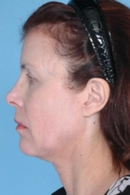 After image 3 Case #79311 - Non-Surgical Focused Ultrasound
