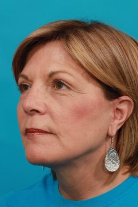After image 2 Case #85636 - Face Lift with Upper Blepharoplasty