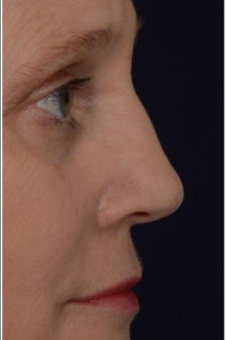 After image 2 Case #86321 - 50 year old woman treated with nonsurgical rhinoplasty