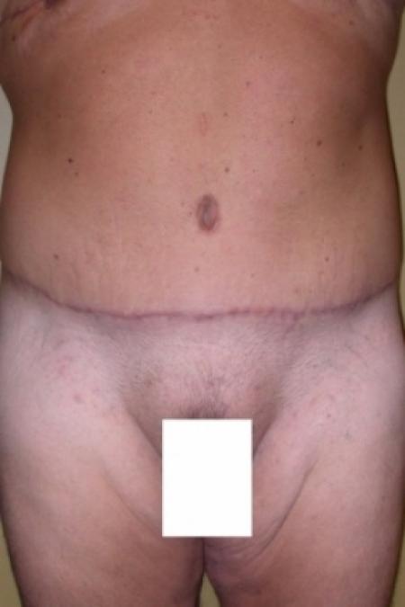 After image 1 Case #79796 - Male Tummy Tuck