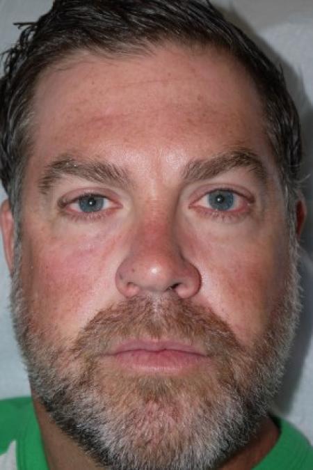 After image 1 Case #82311 - 43 year old after 3 syringes of Juvederm Voluma for cheeks