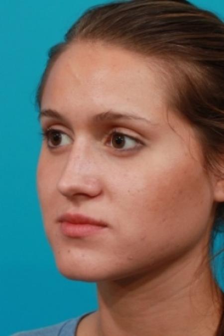 After image 2 Case #79906 - Closed Rhinoplasty
