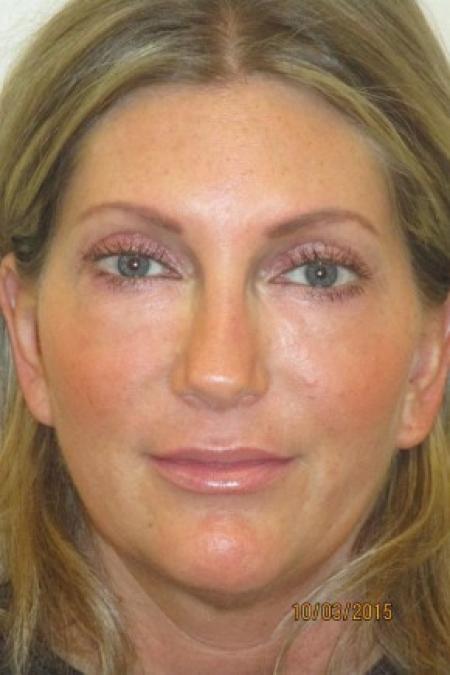 After image 1 Case #82716 - Fat transfer to Face (39 years old)