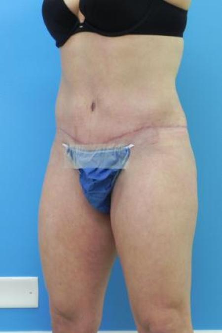 After image 1 Case #80986 - Abdominoplasty 