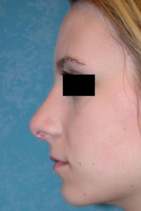 After image 1 Case #81686 - Rhinoplasty