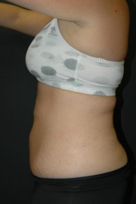 After image 2 Case #80891 - Coolsculpting Procedure on Upper Abdomen