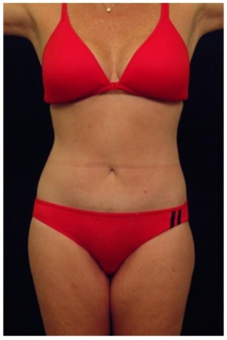 After image 1 Case #81926 - Mommy Makeover