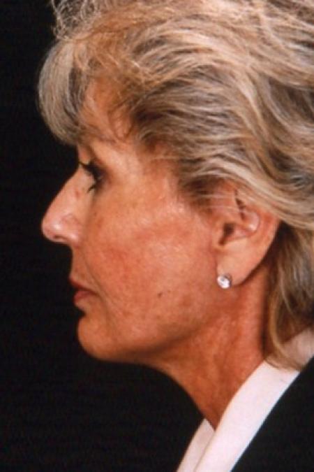 After image 3 Case #81501 - Facelift