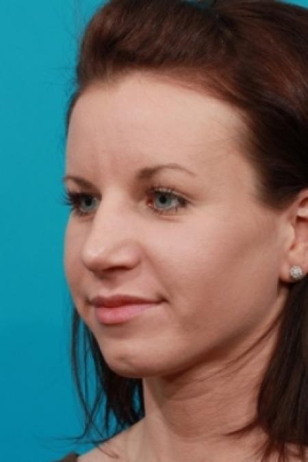 After image 2 Case #78756 - Rhinoplasty (Nose Reshaping)