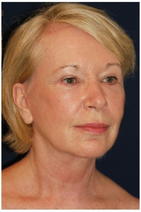 After image 2 Case #82051 - Full Facial Rejuvenation