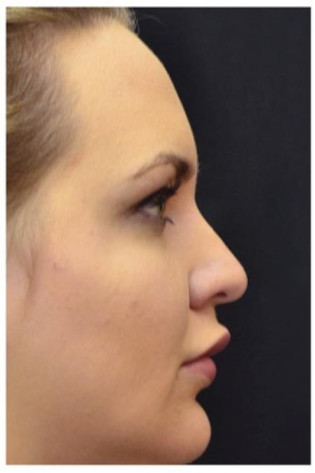 After image 3 Case #86346 - 25 year old woman treated with nonsurgical rhinoplasty
