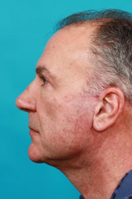 After image 3 Case #86521 - Male Facial Rejuvenation