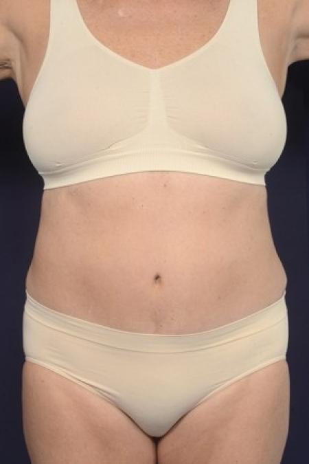 After image 1 Case #87521 - Trunk Liposuction