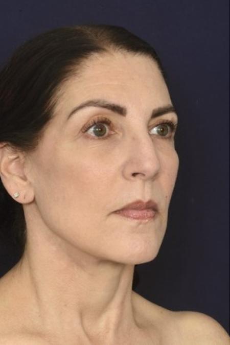 After image 2 Case #87431 - Full Facial Rejuvenation