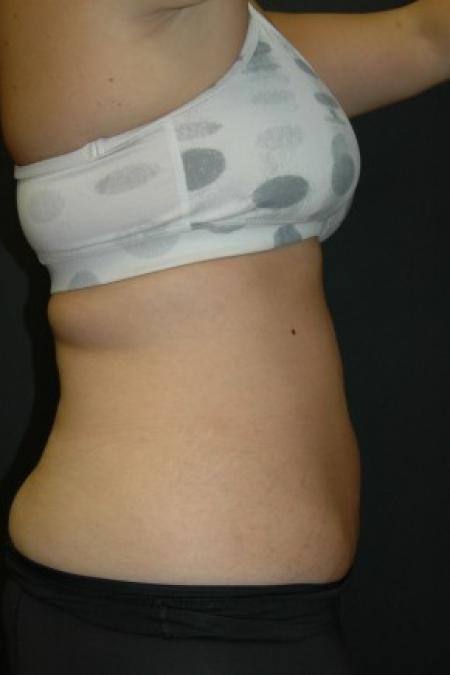 After Case #81341 - Coolsculpting Procedure on Upper Abdomen