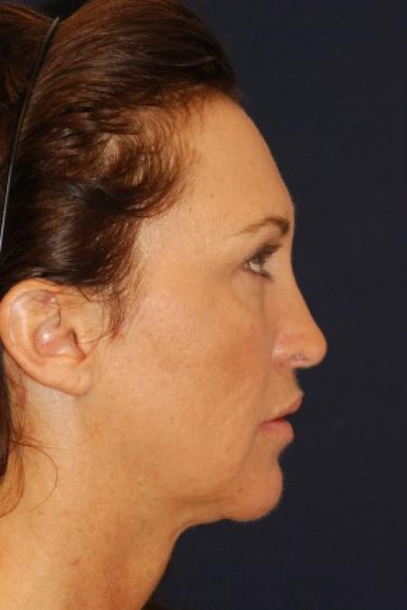 After image 3 Case #87711 - Structural Fat Grafting