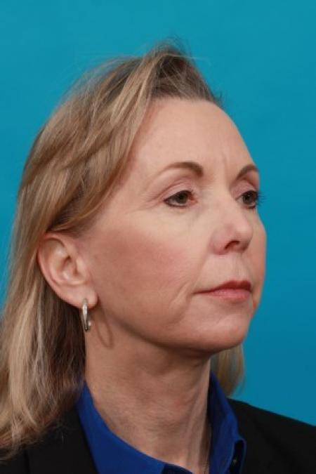 After image 2 Case #86511 - Neck Lift