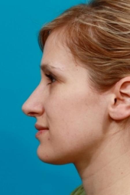 After image 3 Case #78751 - Rhinoplasty (Nose Reshaping)