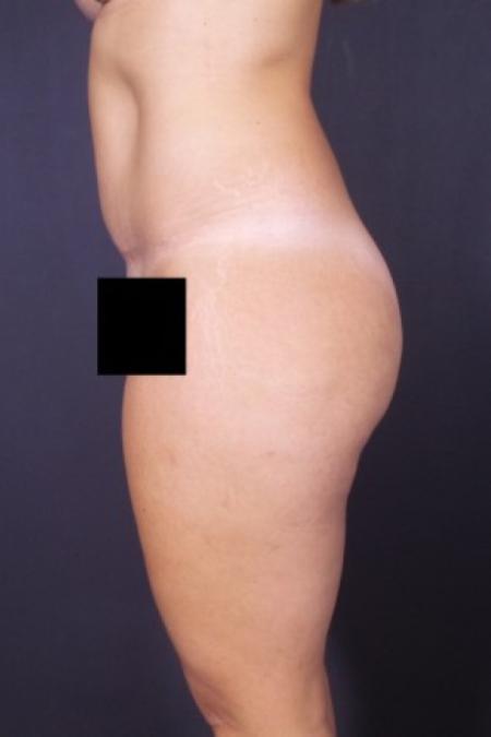 After image 2 Case #84231 - Abdominoplasty 