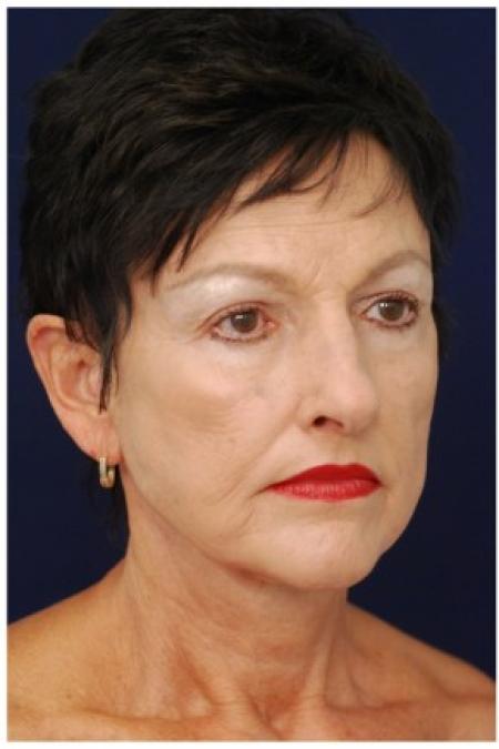 After image 2 Case #82031 - Facelift