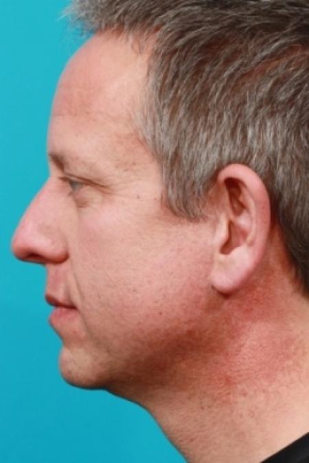 After image 3 Case #78901 - Face / Neck Lift